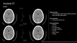 CT scan images of the brain with clinical results, case summary, and parameters for imaging quality and safety.