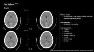 CT scan images of the brain with clinical results, case summary, and parameters for imaging quality and safety.