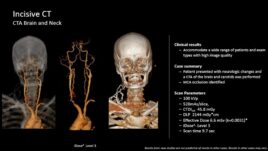 Detailed overview of Philips Incisive CT scan results for brain and neck, highlighting clinical outcomes and scan parameters.