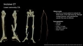 Lower extremity CT scan results show trauma evaluation of the right leg's distal vessels and multiple fractures.
