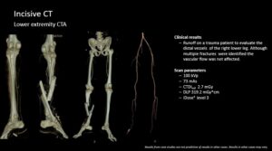 Lower extremity CT scan results show trauma evaluation of the right leg's distal vessels and multiple fractures.